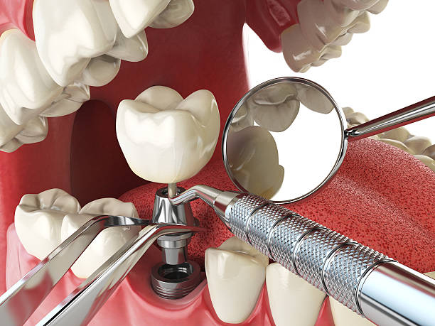 Best Emergency Wisdom Tooth Extraction in Gibbsboro, NJ
